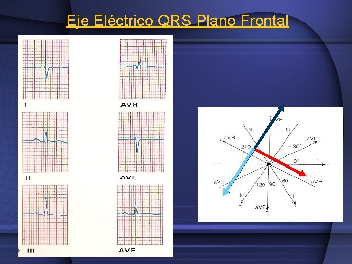 Eje Eléctrico QRS Plano Frontal 