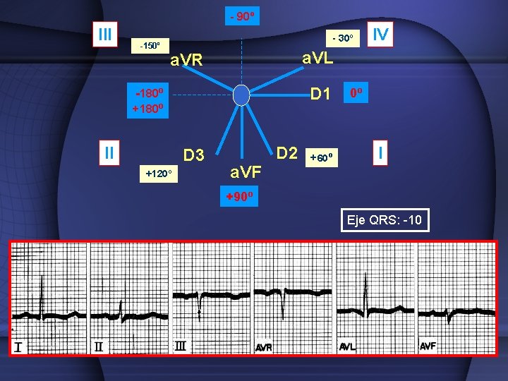 - 90º III -150º - 30º a. VL a. VR D 1 -180º +180º
