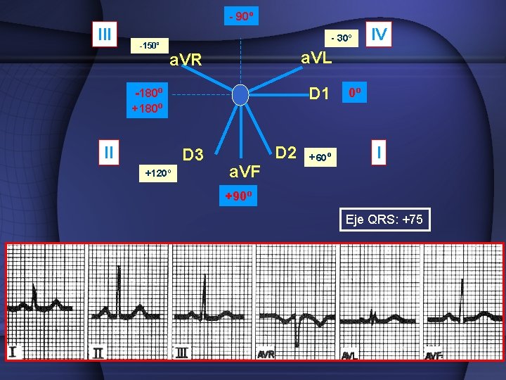 - 90º III -150º - 30º a. VL a. VR D 1 -180º +180º