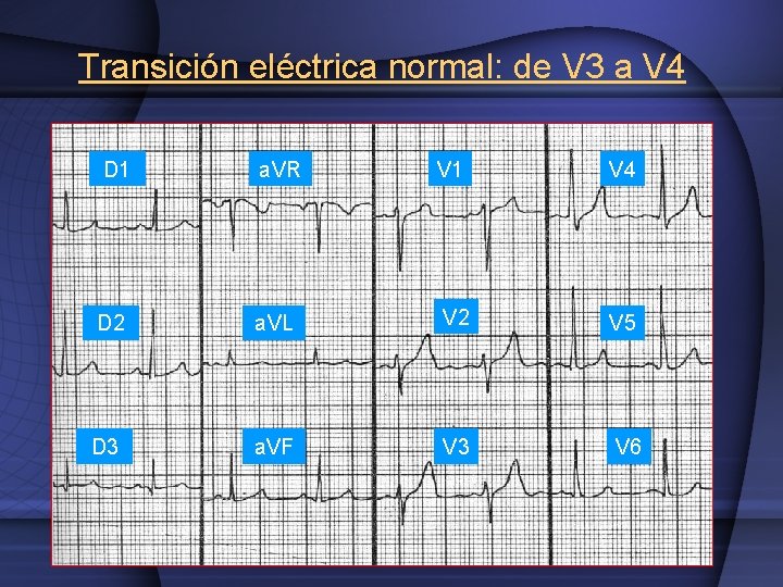 Transición eléctrica normal: de V 3 a V 4 D 1 a. VR V