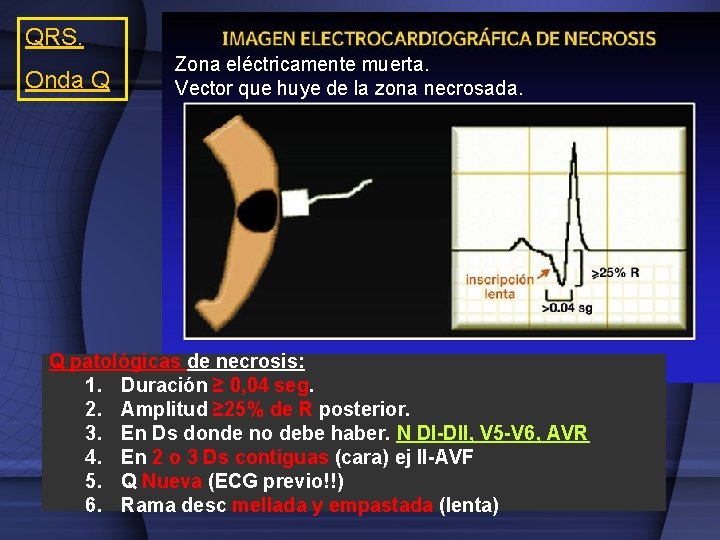 QRS. Onda Q Zona eléctricamente muerta. Vector que huye de la zona necrosada. Q