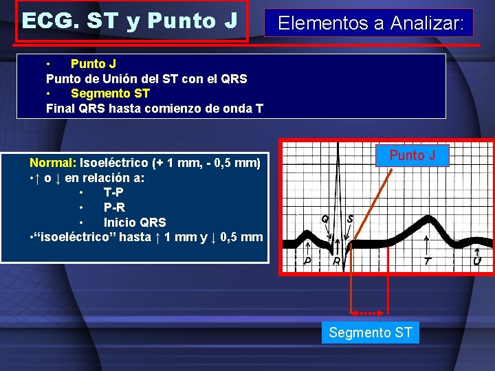 ECG. ST y Punto J Elementos a Analizar: • Punto J Punto de Unión