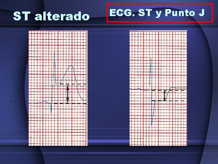 ST alterado ECG. ST y Punto J 