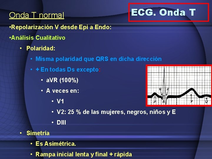 Onda T normal ECG. Onda T • Repolarización V desde Epi a Endo: •