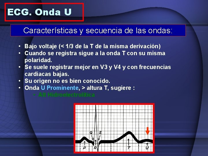 ECG. Onda U Características y secuencia de las ondas: • Bajo voltaje (< 1/3