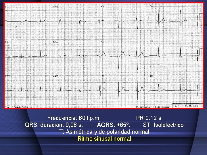 Frecuencia: 60 l. p. m PR: 0. 12 s QRS: duración: 0, 08 s.