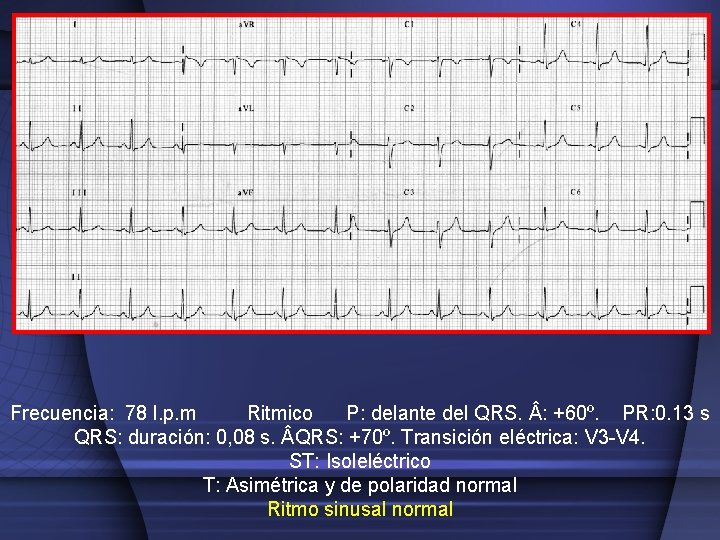 Frecuencia: 78 l. p. m Ritmico P: delante del QRS. : +60º. PR: 0.