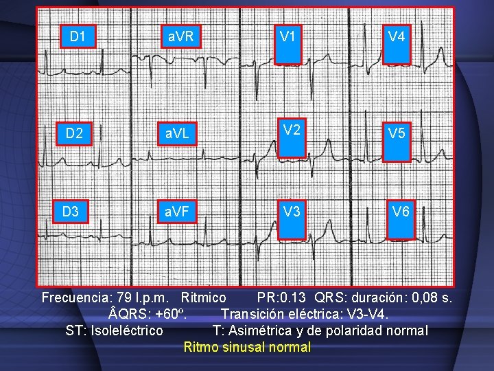 D 1 a. VR V 1 V 4 D 2 a. VL V 2
