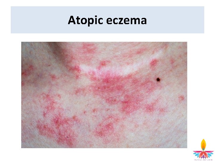 Atopic eczema 