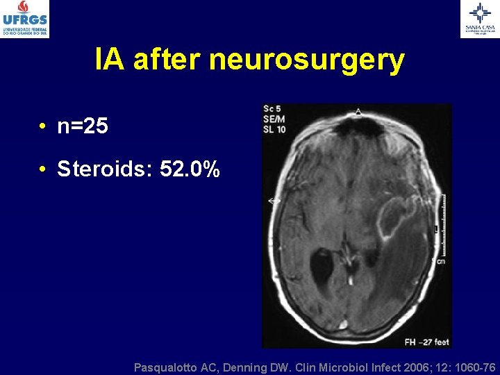 IA after neurosurgery • n=25 • Steroids: 52. 0% Pasqualotto AC, Denning DW. Clin