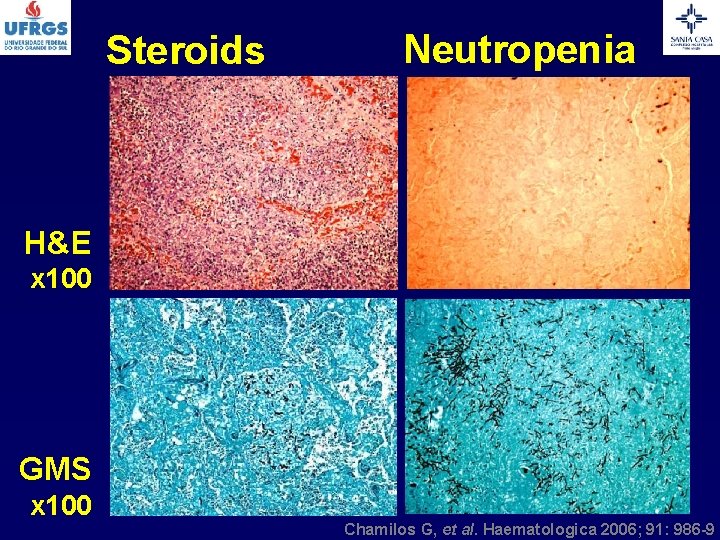 Steroids Neutropenia H&E x 100 GMS x 100 Chamilos G, et al. Haematologica 2006;