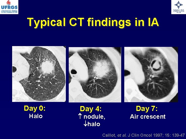 Typical CT findings in IA Day 0: Halo Day 4: Day 7: nodule, halo