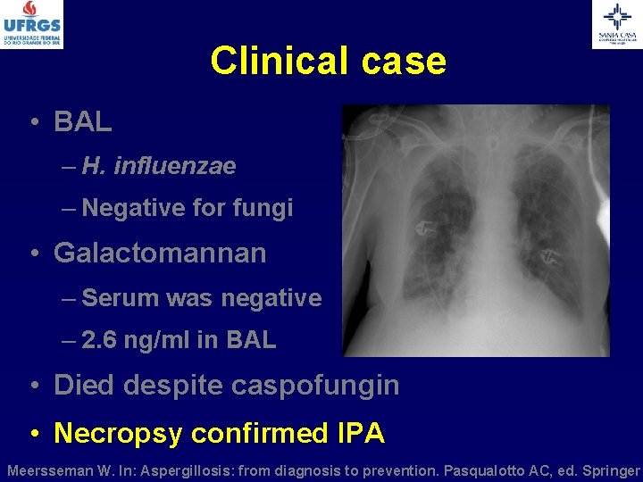 Clinical case • BAL – H. influenzae – Negative for fungi • Galactomannan –