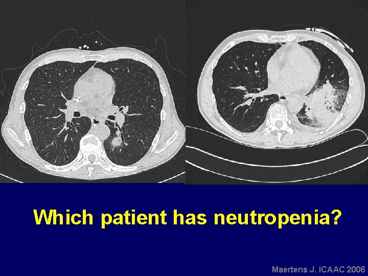 Which patient has neutropenia? Maertens J. ICAAC 2006 