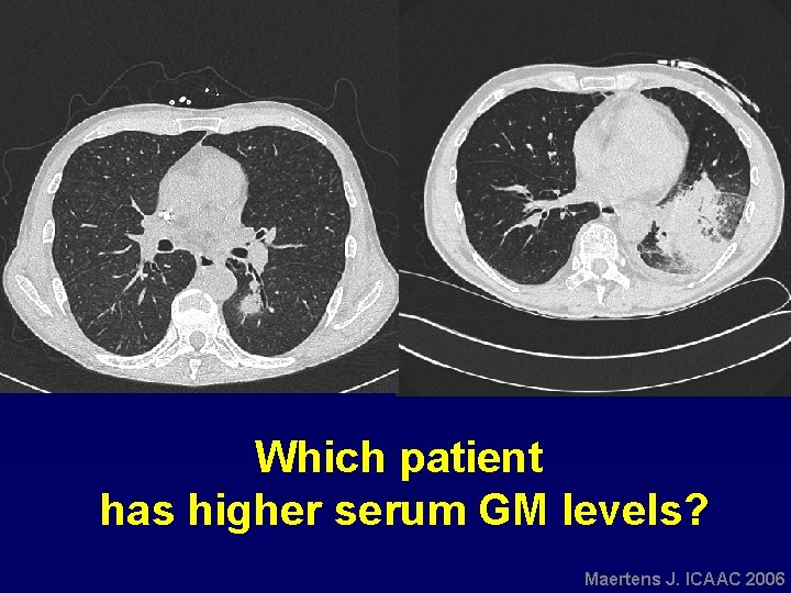 Which patient has higher serum GM levels? Maertens J. ICAAC 2006 