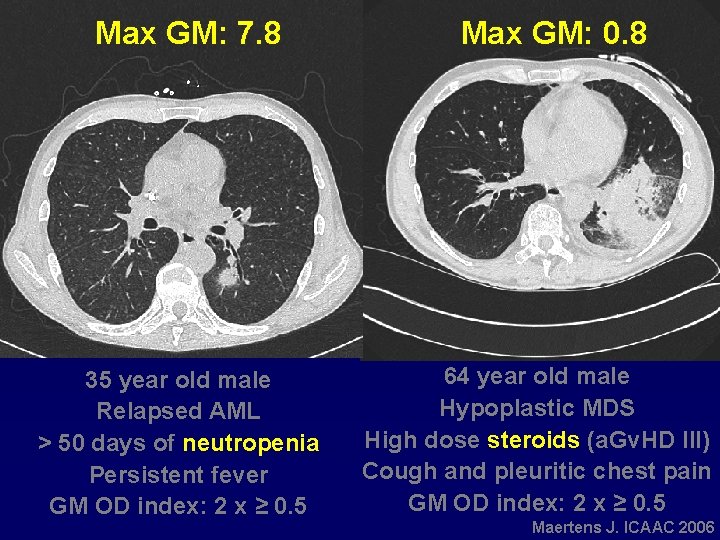 Max GM: 7. 8 35 year old male Relapsed AML > 50 days of