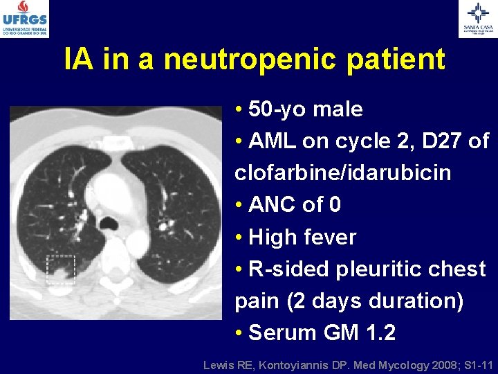 IA in a neutropenic patient • 50 -yo male • AML on cycle 2,