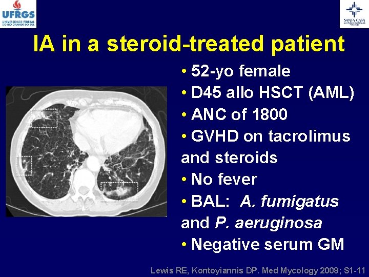 IA in a steroid-treated patient • 52 -yo female • D 45 allo HSCT