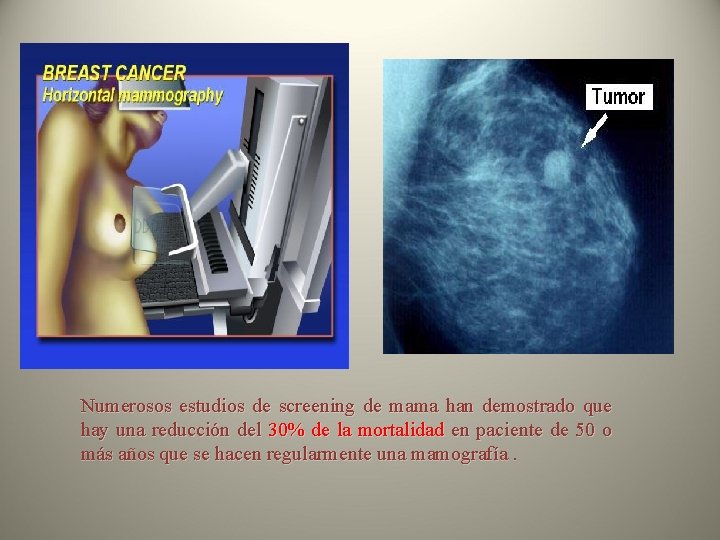 Numerosos estudios de screening de mama han demostrado que hay una reducción del 30%