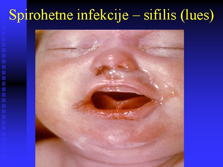 Spirohetne infekcije – sifilis (lues) 