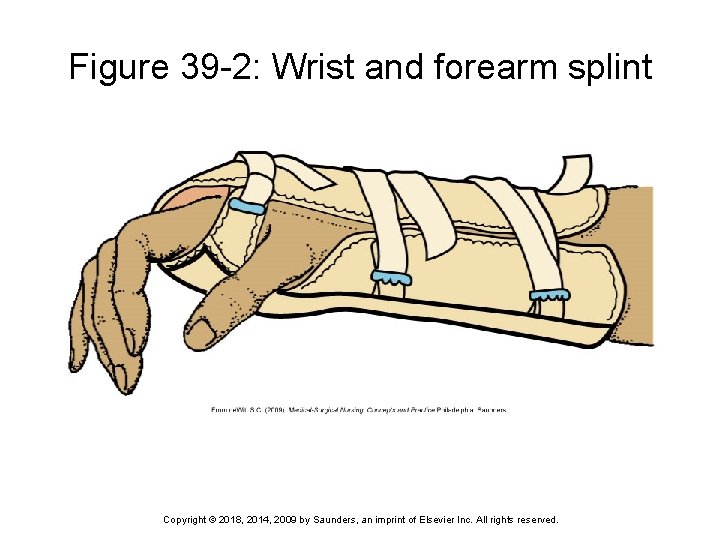 Figure 39 -2: Wrist and forearm splint Copyright © 2018, 2014, 2009 by Saunders,