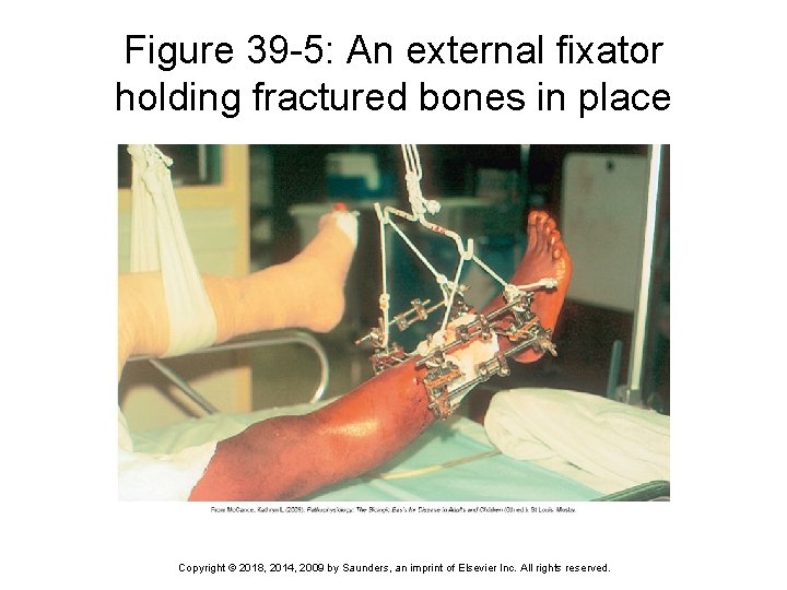 Figure 39 -5: An external fixator holding fractured bones in place Copyright © 2018,