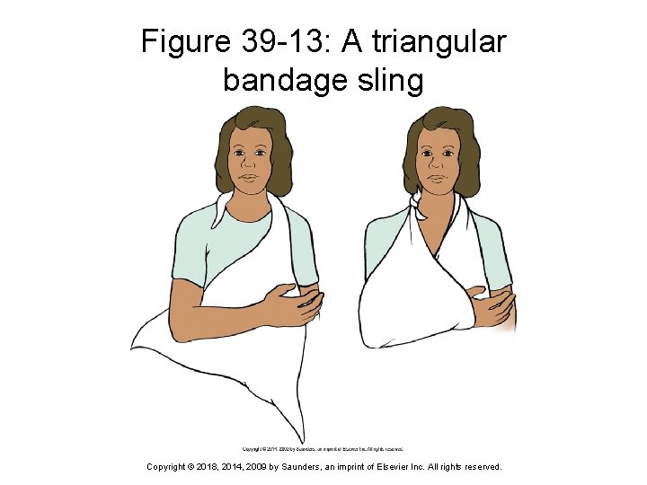 Figure 39 -13: A triangular bandage sling Copyright © 2018, 2014, 2009 by Saunders,