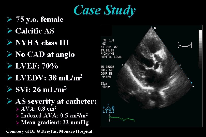 Ø 75 y. o. female Case Study Ø Calcific AS Ø NYHA class III Ø 75 y. o. female Case Study Ø Calcific AS Ø NYHA class III