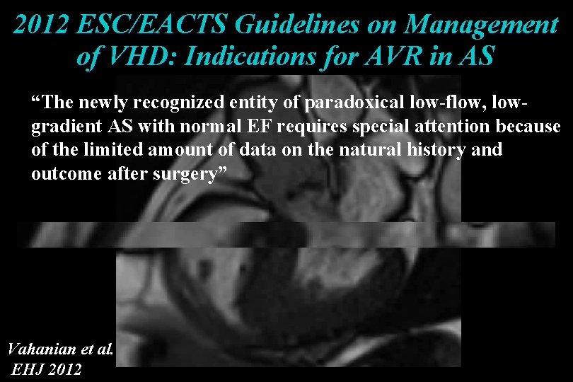 2012 ESC/EACTS Guidelines on Management of VHD: Indications for AVR in AS “The newly 2012 ESC/EACTS Guidelines on Management of VHD: Indications for AVR in AS “The newly