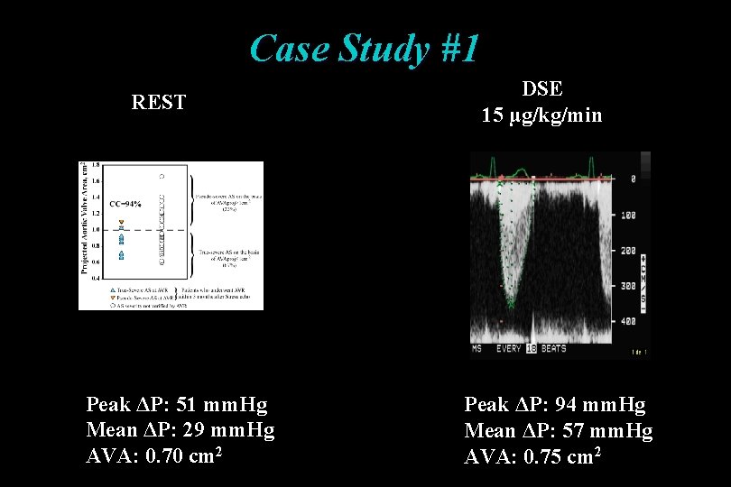 Case Study #1 REST Peak ΔP: 51 mm. Hg Mean ΔP: 29 mm. Hg Case Study #1 REST Peak ΔP: 51 mm. Hg Mean ΔP: 29 mm. Hg