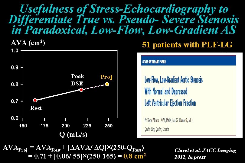 Usefulness of Stress-Echocardiography to Differentiate True vs. Pseudo- Severe Stenosis in Paradoxical, Low-Flow, Low-Gradient Usefulness of Stress-Echocardiography to Differentiate True vs. Pseudo- Severe Stenosis in Paradoxical, Low-Flow, Low-Gradient