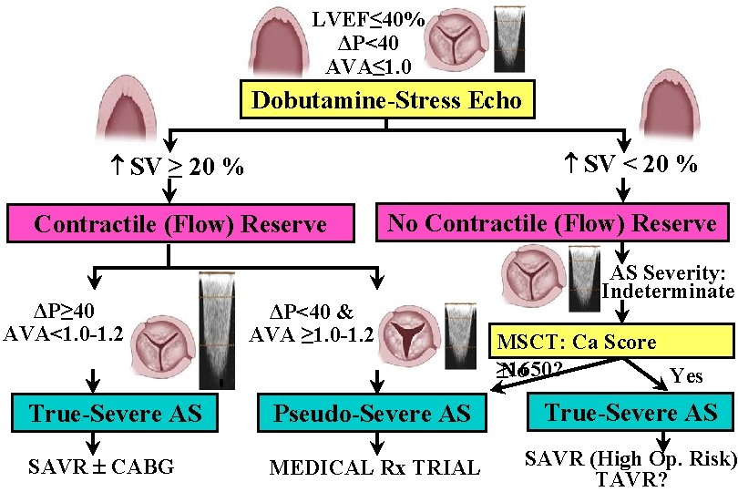 LVEF≤ 40% ΔP<40 AVA≤ 1. 0 Dobutamine-Stress Echo SV < 20 % SV ≥ LVEF≤ 40% ΔP<40 AVA≤ 1. 0 Dobutamine-Stress Echo SV < 20 % SV ≥
