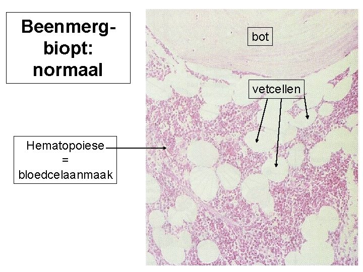 Beenmergbiopt: normaal bot vetcellen Hematopoiese = bloedcelaanmaak 