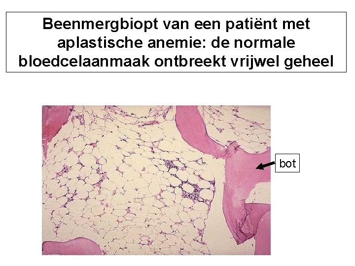 Beenmergbiopt van een patiënt met aplastische anemie: de normale bloedcelaanmaak ontbreekt vrijwel geheel bot