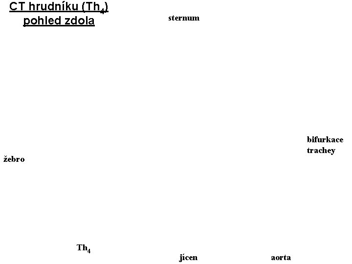 CT hrudníku (Th 4) pohled zdola sternum bifurkace trachey žebro Th 4 jícen aorta