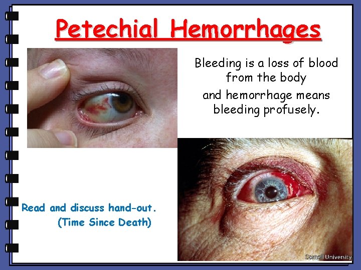 Petechial Hemorrhages Bleeding is a loss of blood from the body and hemorrhage means