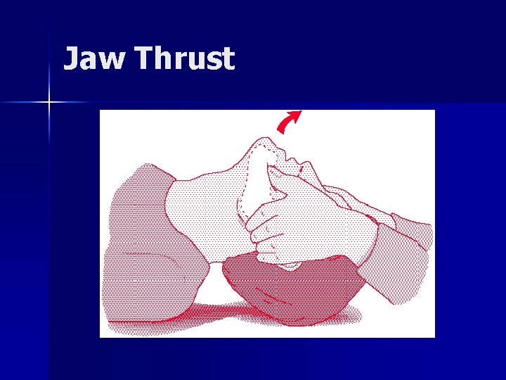 Jaw Thrust 