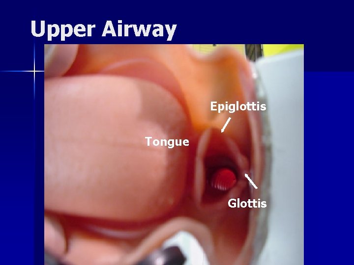 Upper Airway Epiglottis Tongue Glottis 