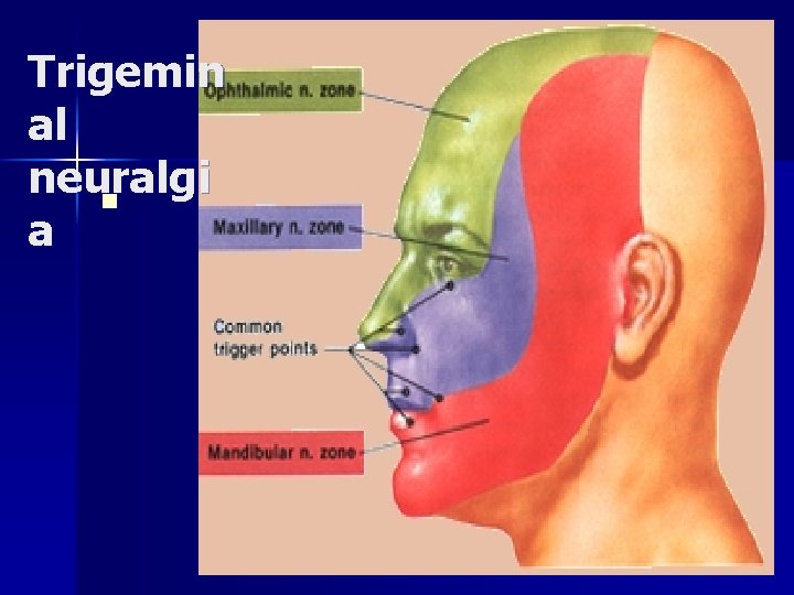 Trigemin al neuralgi n a 