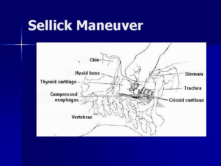 Sellick Maneuver 