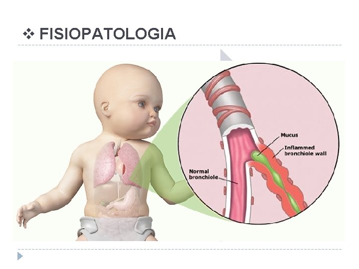 v FISIOPATOLOGIA INFECÇÃO (VSR) INFLAMAÇÃO (EDEMA, ACÚMULO DE MUCO, FIBRINA E RESTOS CELULARES) RESTRIÇÃO/