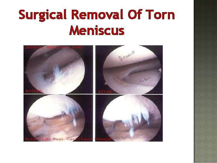 Surgical Removal Of Torn Meniscus 