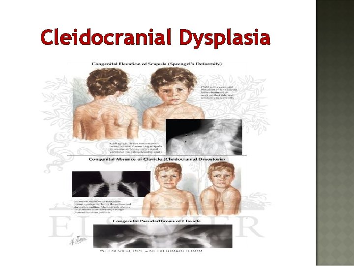 Cleidocranial Dysplasia 