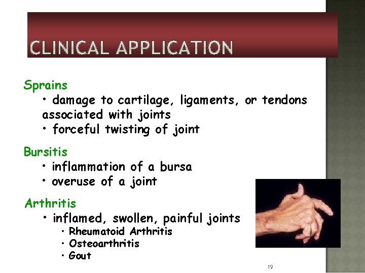 Sprains • damage to cartilage, ligaments, or tendons associated with joints • forceful twisting