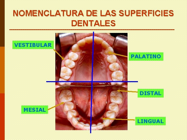 NOMENCLATURA DE LAS SUPERFICIES DENTALES VESTIBULAR PALATINO DISTAL MESIAL LINGUAL 