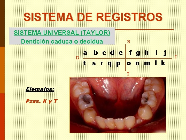 SISTEMA DE REGISTROS SISTEMA UNIVERSAL (TAYLOR) Dentición caduca o decidua D a b c