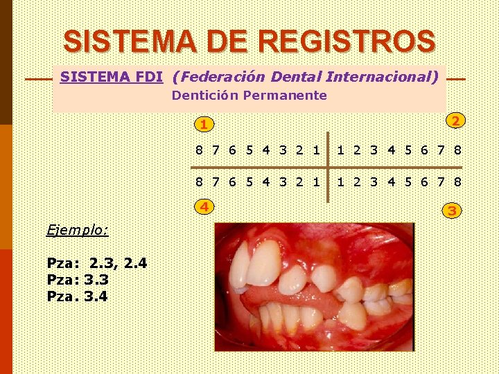 SISTEMA DE REGISTROS SISTEMA FDI (Federación Dental Internacional) Dentición Permanente 1 8 7 6