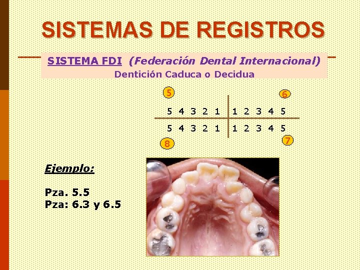 SISTEMAS DE REGISTROS SISTEMA FDI (Federación Dental Internacional) Dentición Caduca o Decidua 5 5