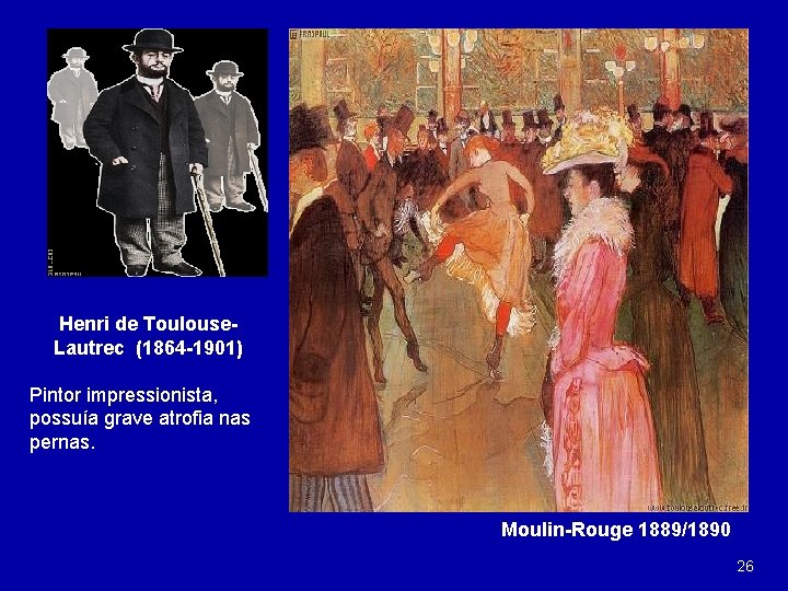 Henri de Toulouse. Lautrec (1864 -1901) Pintor impressionista, possuía grave atrofia nas pernas. Moulin-Rouge