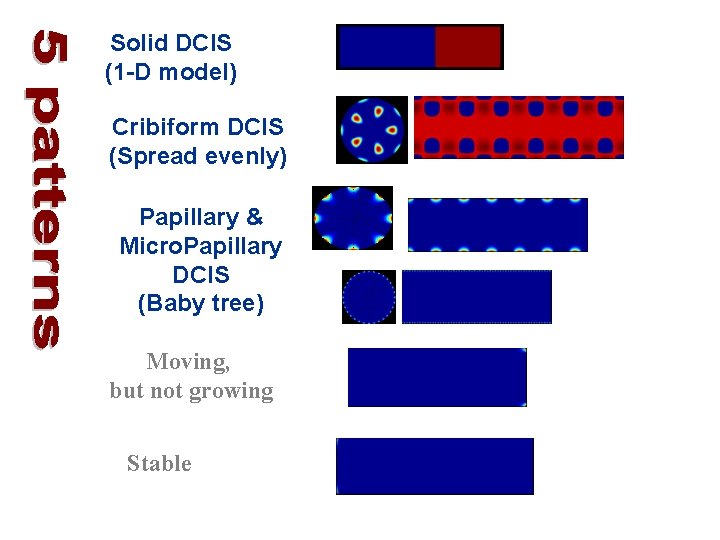 Solid DCIS (1 -D model) Cribiform DCIS (Spread evenly) Papillary & Micro. Papillary DCIS